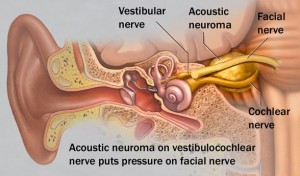 acoustic-neuroma-.33190846_std