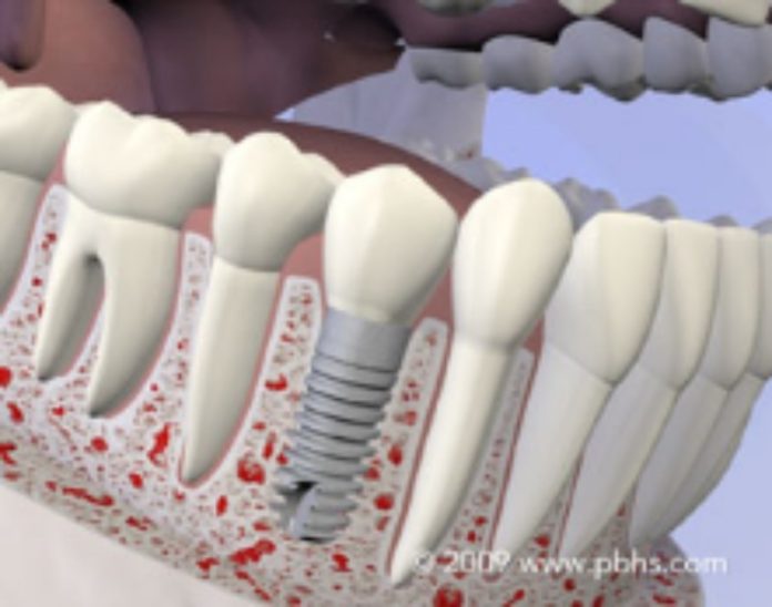 dental implant